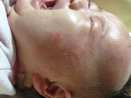 アトピーと乳児湿疹の違い　マクロビオティック